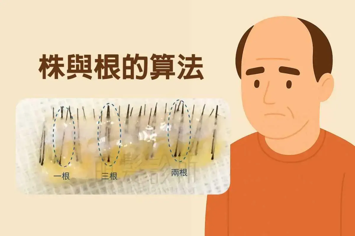 植髮點解用「株」計?